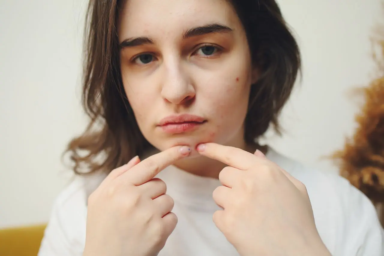 Can Grapes Cause Acne? Image