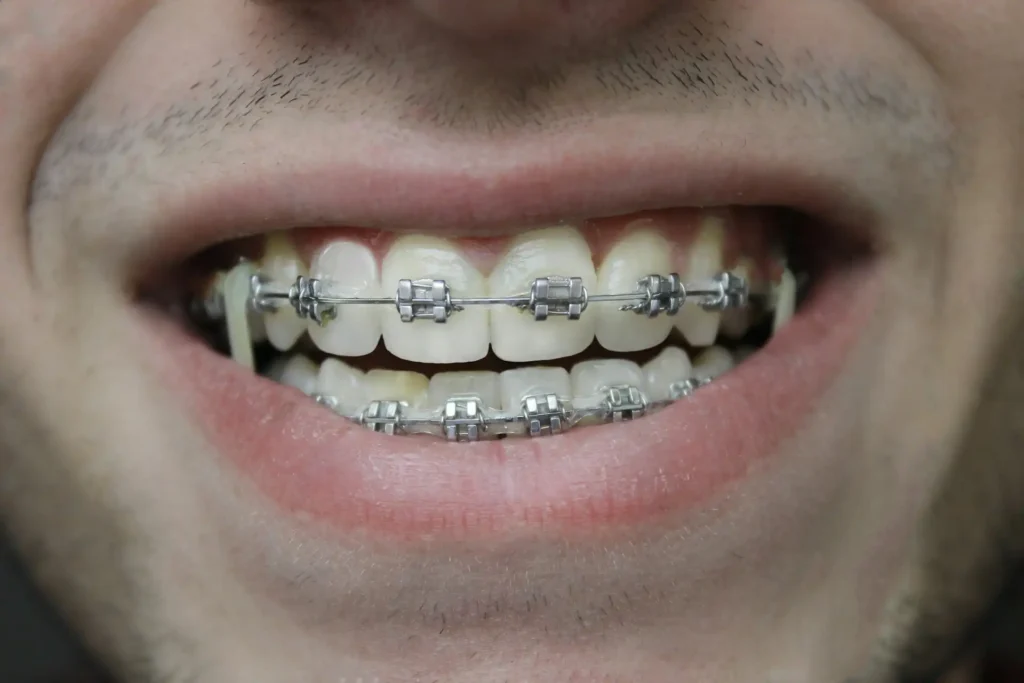 Eat Grapes with Braces Image